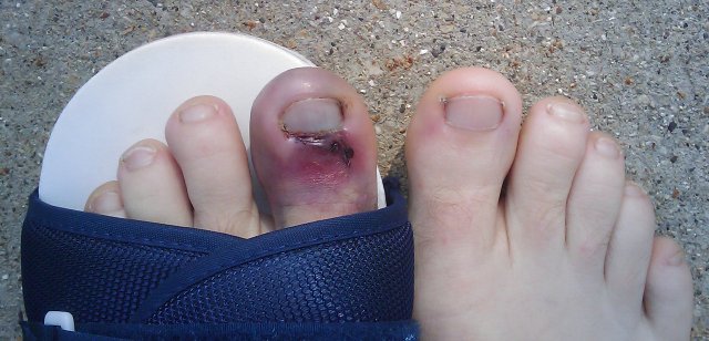 steel toe boot injuries